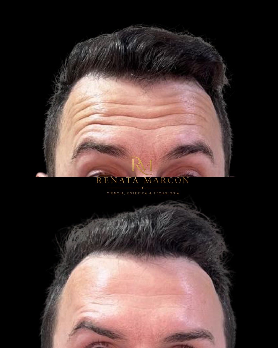 Antes e depois de Botox