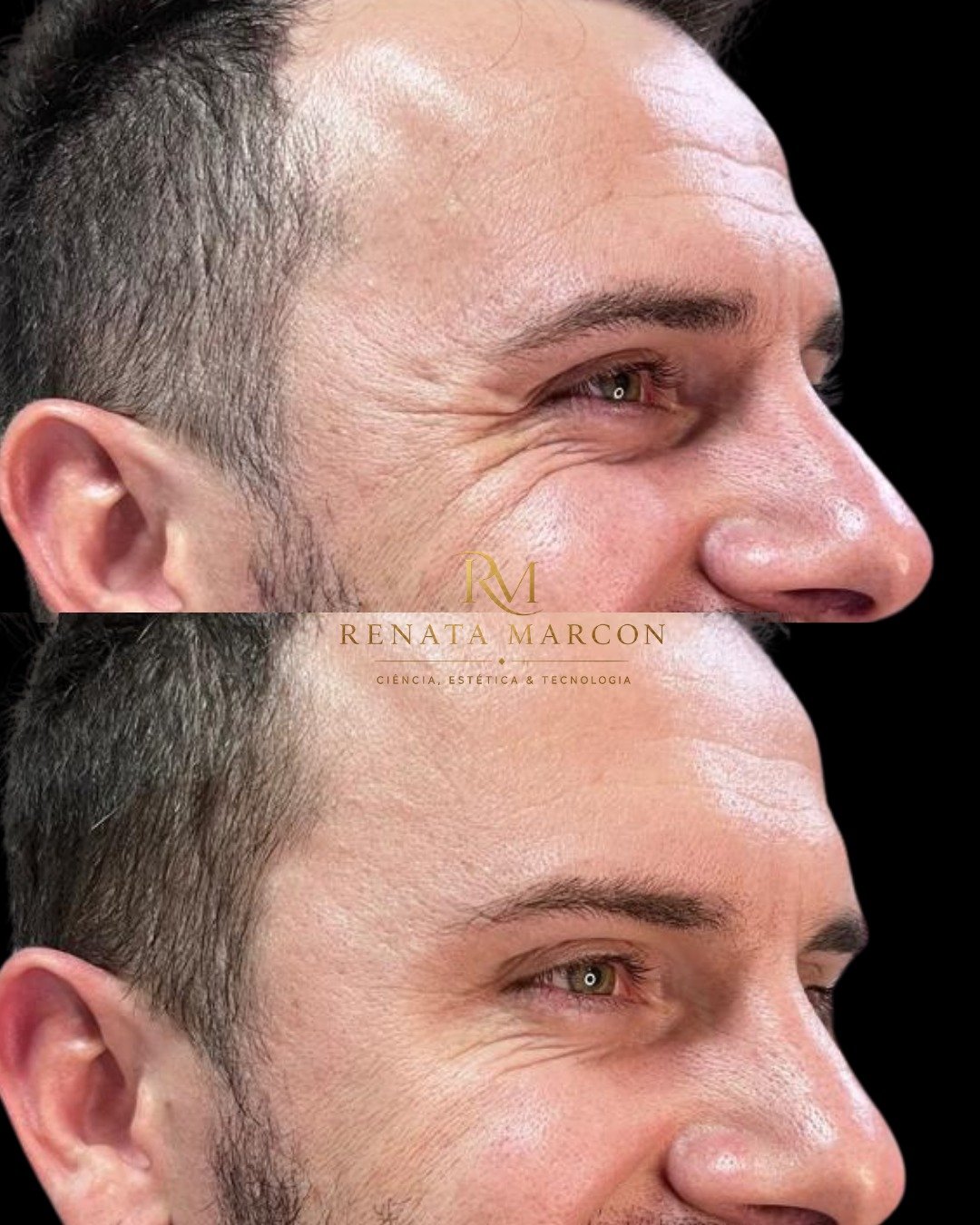Antes e depois de Botox