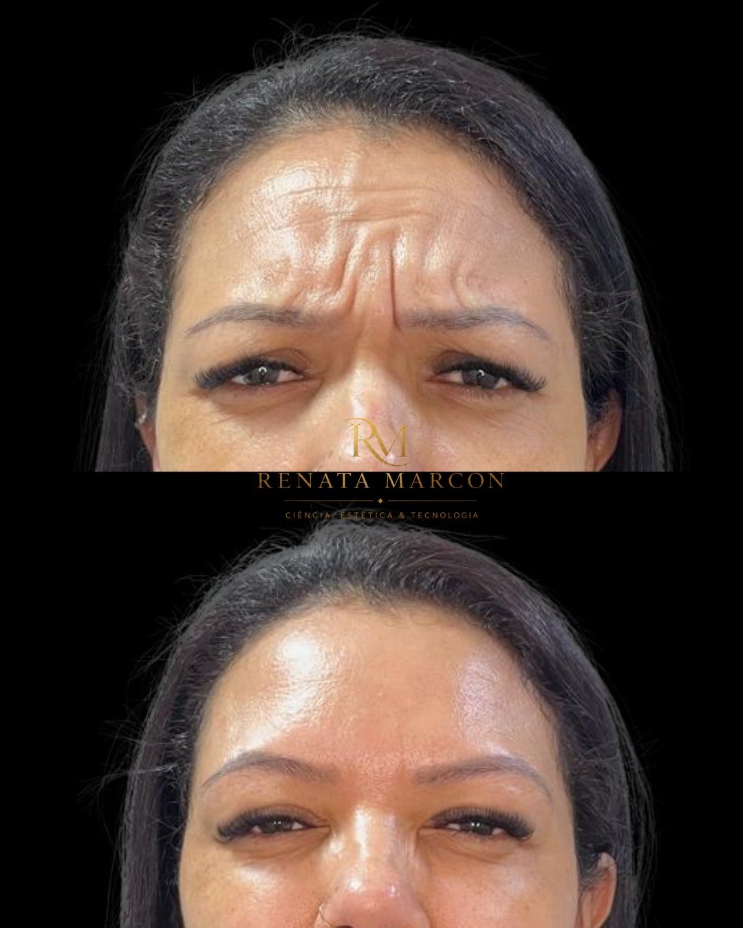 Antes e depois de Botox
