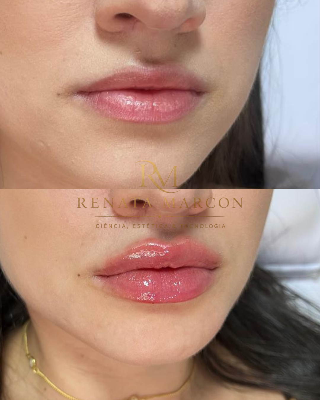 Antes e depois de Preenchimento Labial