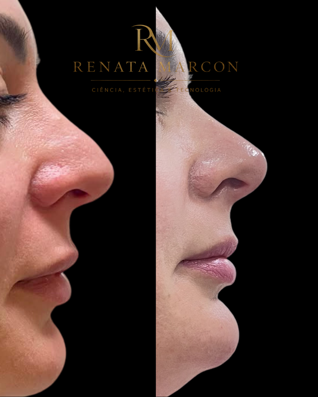 Antes e depois de Rinomodelação